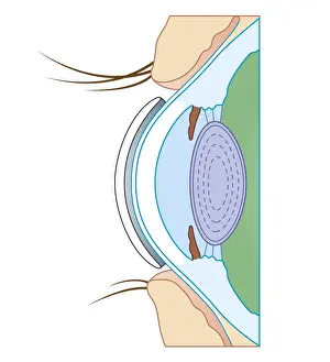 Eyesight Prints: Cross section biomedical illustration of soft contact lens on eye