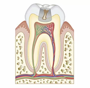 Images Dated 24th October 2011: Cross section biomedical illustration of tooth decay before dental filling