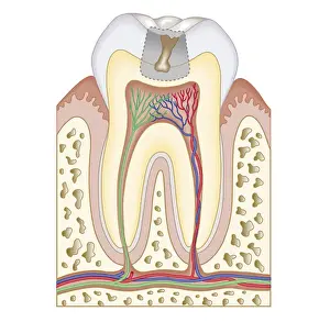 Cross section biomedical illustration of tooth decay before dental filling