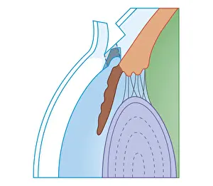 Eyesight Prints: Cross section biomedical illustration of Trabeculectomy