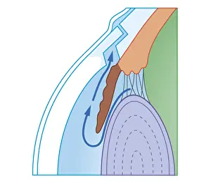 Eyesight Prints: Cross section biomedical illustration of Trabeculectomy procedure to treat glaucoma by relieving Intraocular pressure
