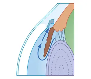 Eyesight Prints: Cross section biomedical illustration of Trabeculectomy procedure to treat glaucoma by relieving Intraocular pressure