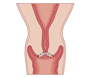 Cervix Prints: Cross section biomedical illustration of treating cervical intraepithelial neoplasia with large loop excision of