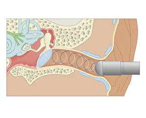 Cross section biomedical illustration of tympanometer probe inserted in ear to test middle ear and eardrum (Tympanometry)