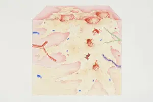 One Object Prints: Cross-section diagram of a cancerous tumour including calcium deposits