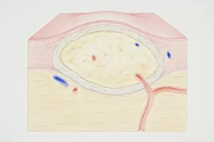 Cross-section diagram of a non-cancerous tumour including a fibrous capsule, tissue layer and blood vessel