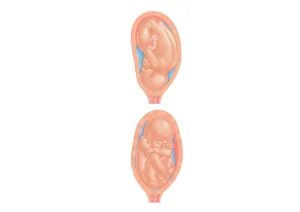 Uterus Prints: Cross section digital illustration of foetus in normal position and breech position