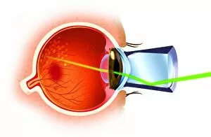 Images Dated 7th December 2006: Cross section of eye ball, laser ray entering through pupil, directed at eye nerves