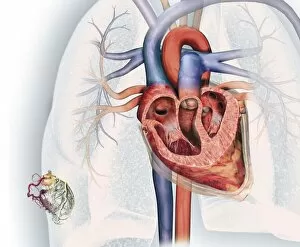 Cross section of human heart and, bottom left, coronary system with aorta, coronary arteries