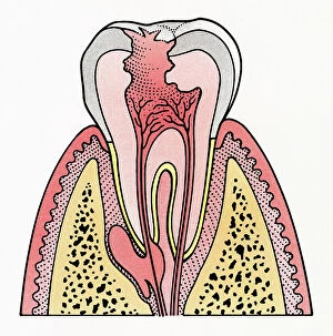 Dorling Kindersley Prints Collection: Cross section illustration showing tooth decay
