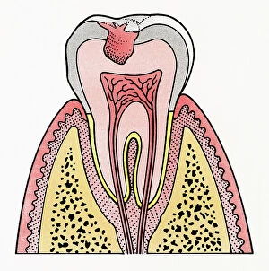 Dorling Kindersley Prints Collection: Cross section illustration showing tooth decay