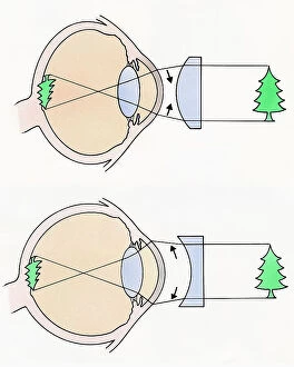 Dorling Kindersley Prints Collection: Cross section illustrations of human eyes with concave and concave lenses looking at green tree