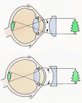 Long Prints: Cross section illustrations of human eyes with concave and concave lenses looking at green tree