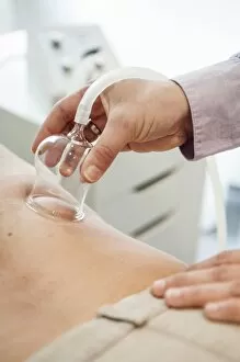 Cupping therapy, cupping glass on a patients back