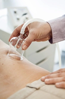 Images Dated 30th November 2012: Cupping therapy, cupping glass on a patients back