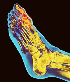 Vertical Image Gallery: Degenerative foot deformation, X-ray