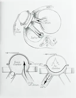Diagram of Artificial Heart Compression