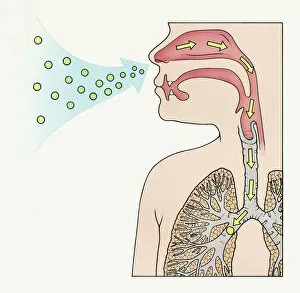 A diagram showing aspergilloma affecting human lung