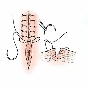 Diagram showing surgical repair of a torn vagina