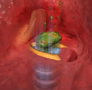 Trachea Prints: Digital cross section illustration of food entering the trachea the wrong way