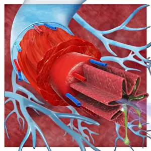Bronchi Prints: Digital cross section illustration of trachea and bronchioles in human lung of asthmatic