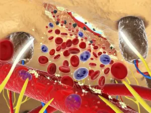 Digital cross section illustration wound below human skin showing red and white blood cells and yell