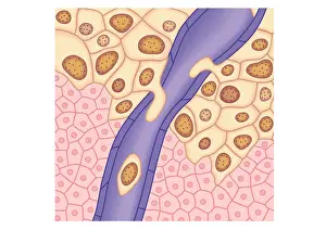 Cancer Prints: Digital illustration of breached lymph vessel as primary tumour grows and its cells invade adjacent tissues