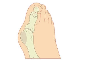 Dorling Kindersley Prints Collection: Digital illustration of bunion with enlargement of bone around joint at base of big toe
