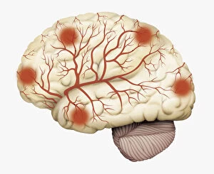 Images Dated 13th January 2010: Digital illustration of human brain showing blood vessels, and areas of dead tissue highlighted in
