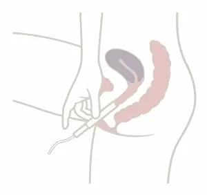 Images Dated 15th May 2017: Digital illustration of inserting tampon in vagina