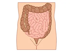 Mid Section Prints: Digital illustration of location of intussusception in small intestine