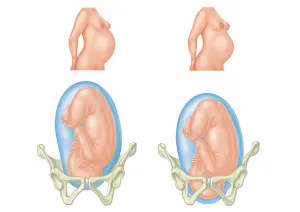 Uterus Prints: Digital illustration of pregnant two women and position of each babys head entering and inside pelvic area