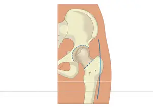 Digital illustration of prosthetic hip joint replacement