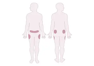 Belly Prints: Digital illustration representing areas of fat distribution on belly, hips and thighs