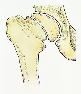 Images Dated 14th May 2009: Digital illustration showing degeneration of hip joint known as Perthes disease