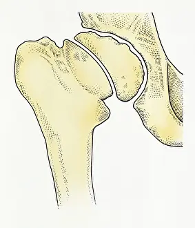 Pelvis Prints: Digital illustration showing degeneration of hip joint known as Perthes disease
