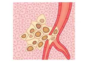 Blood Vessel Prints: Digital illustration showing secondary tumour where cancerous cells have divided and lodged in narrow blood vessel
