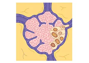 Digital illustration of tumour in lymph node