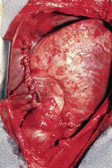 Organ Transplant Prints: Donor's Heart in Thomas Chest