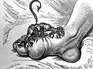 Disease Prints: Drawing of The Gout, ca. 1799