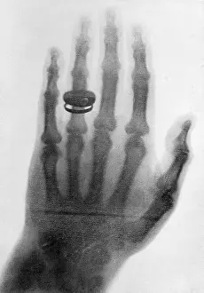 X Ray Prints: Early X-Ray of Hand