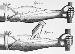 Bandage Prints: Engraving of a Circulation Experiment by William Harvey