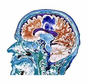 Bizarre Collection: Glioblastoma brain cancer, CT scan