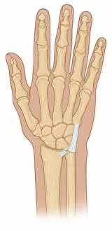 Human Internal Organ Collection: Hand bones with injury
