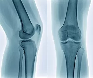 Radiography Collection: Healthy knee, X-ray