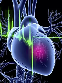 Science And Technology Gallery: Heart attack and ECG trace