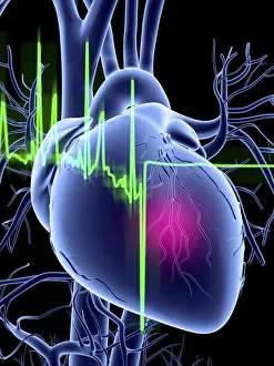 Line Gallery: Heart attack and ECG trace