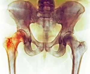 Images Dated 24th September 2015: Hip before hip replacement surgery, X-ray