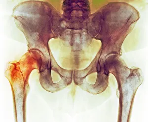 No One Collection: Hip before hip replacement surgery, X-ray