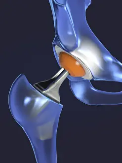 3d Rendering Prints: Hip replacement, illustration